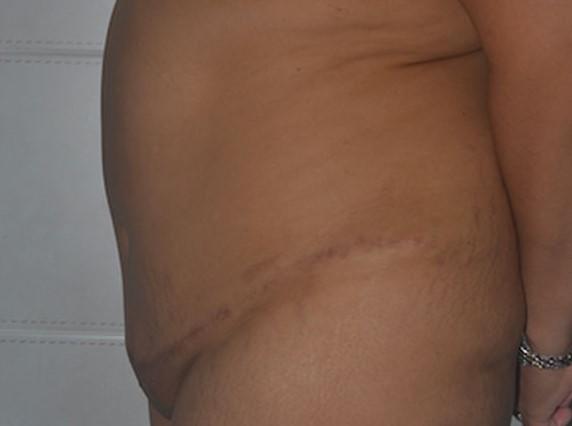 Mini Tummy Tuck after at Dr. Roman Rayham, MD in Brooklyn, NY