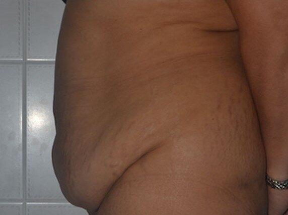 Mini Tummy Tuck before at Dr. Roman Rayham, MD in Brooklyn, NY