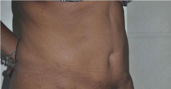 Mini Tummy Tuck after at Dr. Roman Rayham, MD in Brooklyn, NY