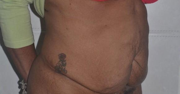 Mini Tummy Tuck before at Dr. Roman Rayham, MD in Brooklyn, NY
