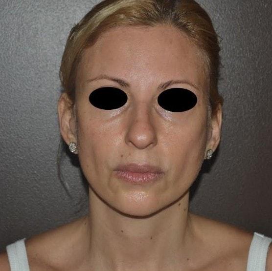 Deep Plane Facelift before at Dr. Roman Rayham, MD in Brooklyn, NY