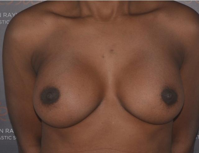 Breast Lift after at Dr. Roman Rayham, MD in Brooklyn, NY