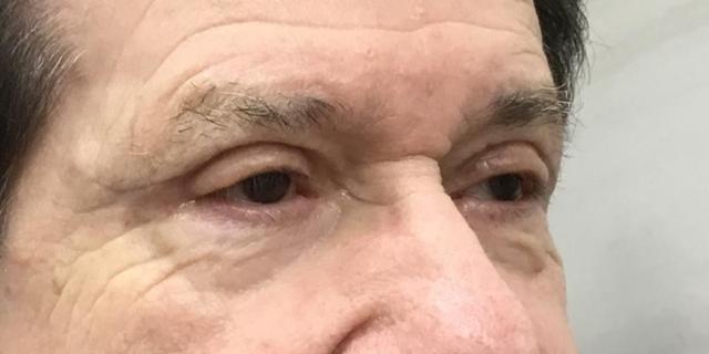 Blepharoplasty after at Dr. Roman Rayham, MD in Brooklyn, NY