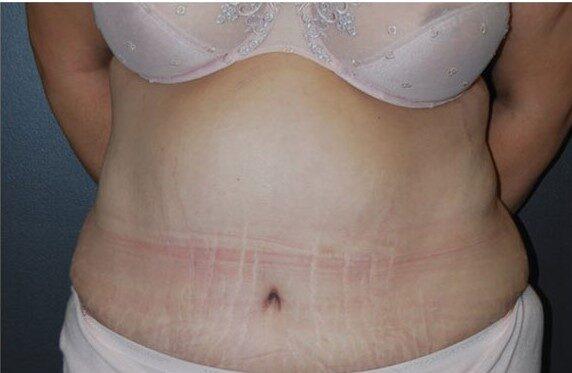 Mini Tummy Tuck after at Dr. Roman Rayham, MD in Brooklyn, NY