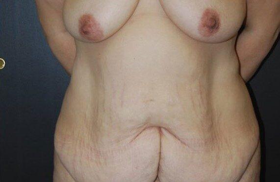 Mini Tummy Tuck before at Dr. Roman Rayham, MD in Brooklyn, NY