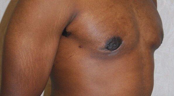 Gynecomastia Surgery after at Dr. Roman Rayham, MD in Brooklyn, NY