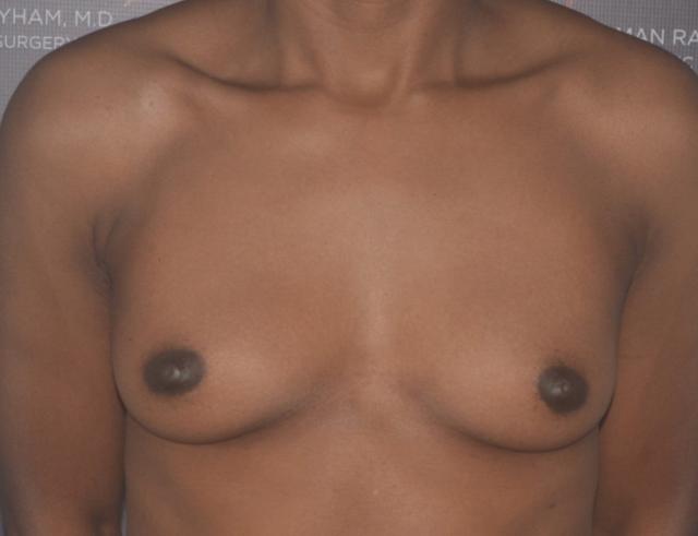 Breast Lift before at Dr. Roman Rayham, MD in Brooklyn, NY