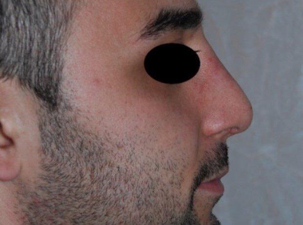 Rhinoplasty after at Dr. Roman Rayham, MD in Brooklyn, NY