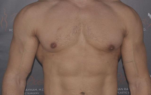 Gynecomastia Surgery after at Dr. Roman Rayham, MD in Brooklyn, NY
