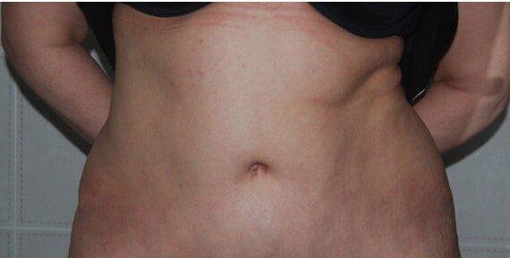 Mini Tummy Tuck after at Dr. Roman Rayham, MD in Brooklyn, NY