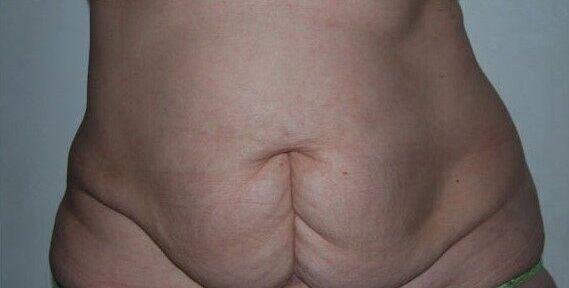 Mini Tummy Tuck before at Dr. Roman Rayham, MD in Brooklyn, NY