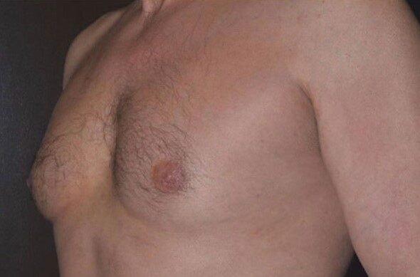Gynecomastia Surgery before at Dr. Roman Rayham, MD in Brooklyn, NY
