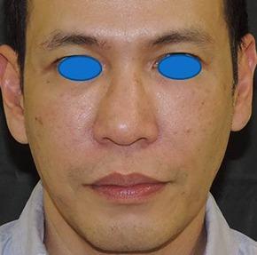 Chase Lay, MD | Facial Plastics & Asian Eyelid Surgery after — San Jose, CA