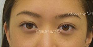 Chase Lay, MD | Facial Plastics & Asian Eyelid Surgery after — San Jose, CA
