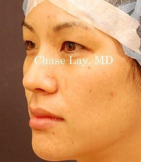 Blepharoplasty before at Chase Lay, MD | Facial Plastics & Asian Eyelid Surgery in San Jose, CA