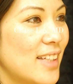Blepharoplasty after at Chase Lay, MD | Facial Plastics & Asian Eyelid Surgery in San Jose, CA