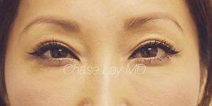Blepharoplasty after at Chase Lay, MD | Facial Plastics & Asian Eyelid Surgery in San Jose, CA