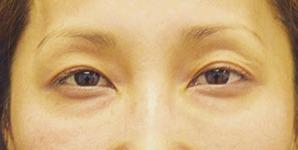 Blepharoplasty before at Chase Lay, MD | Facial Plastics & Asian Eyelid Surgery in San Jose, CA
