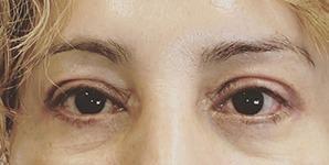 Chase Lay, MD | Facial Plastics & Asian Eyelid Surgery after — San Jose, CA