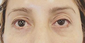 Blepharoplasty before at Chase Lay, MD | Facial Plastics & Asian Eyelid Surgery in San Jose, CA