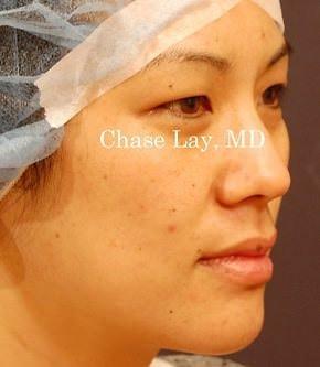 Blepharoplasty before at Chase Lay, MD | Facial Plastics & Asian Eyelid Surgery in San Jose, CA