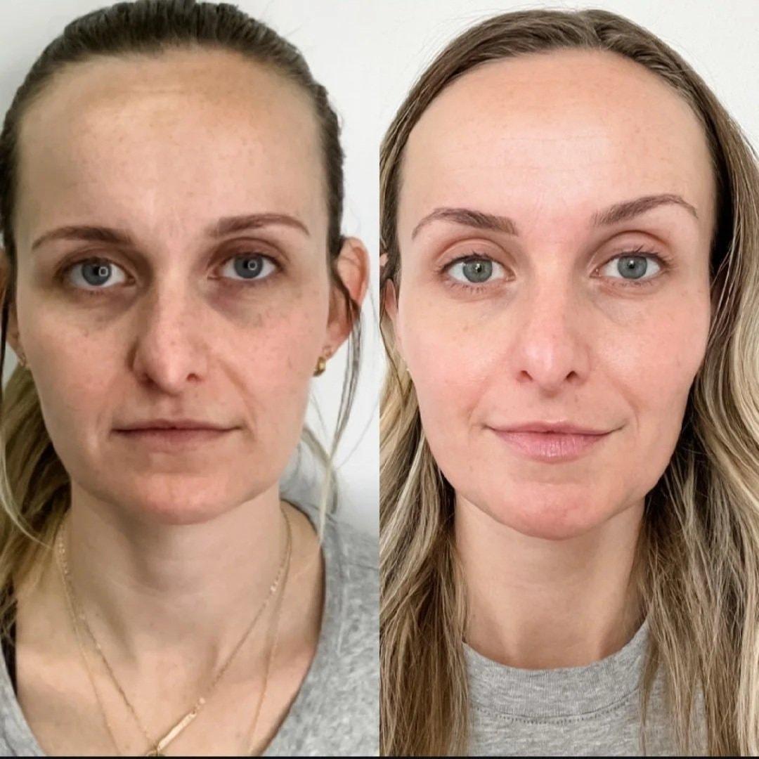 Bocaba Medspa laser treatment result — Sandy, UT