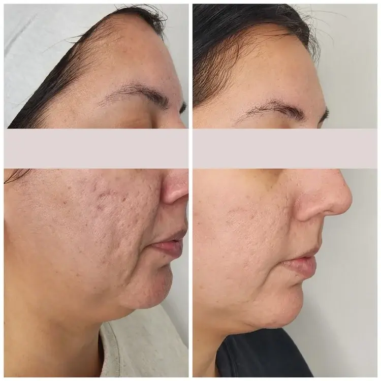 Bocaba Medspa laser treatment result — Sandy, UT