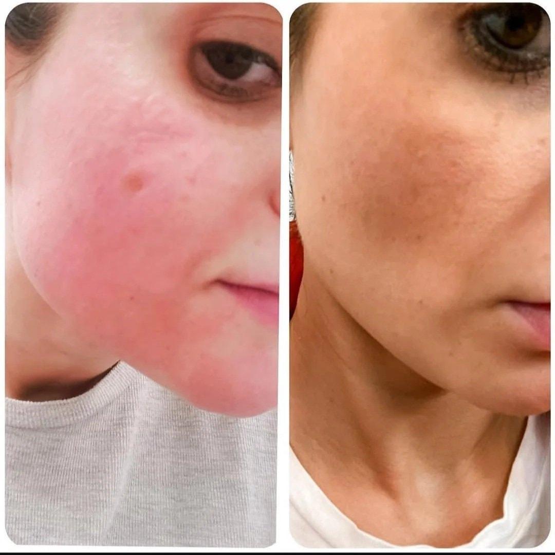 Bocaba Medspa laser treatment result — Sandy, UT