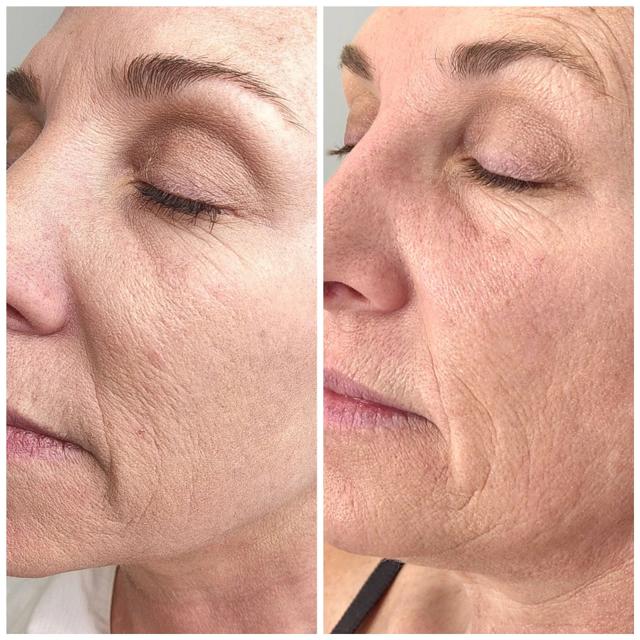 Microneedling result at Bocaba Medspa in Sandy, UT