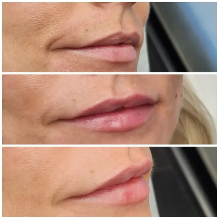 Bocaba Medspa lip filler result — Sandy, UT