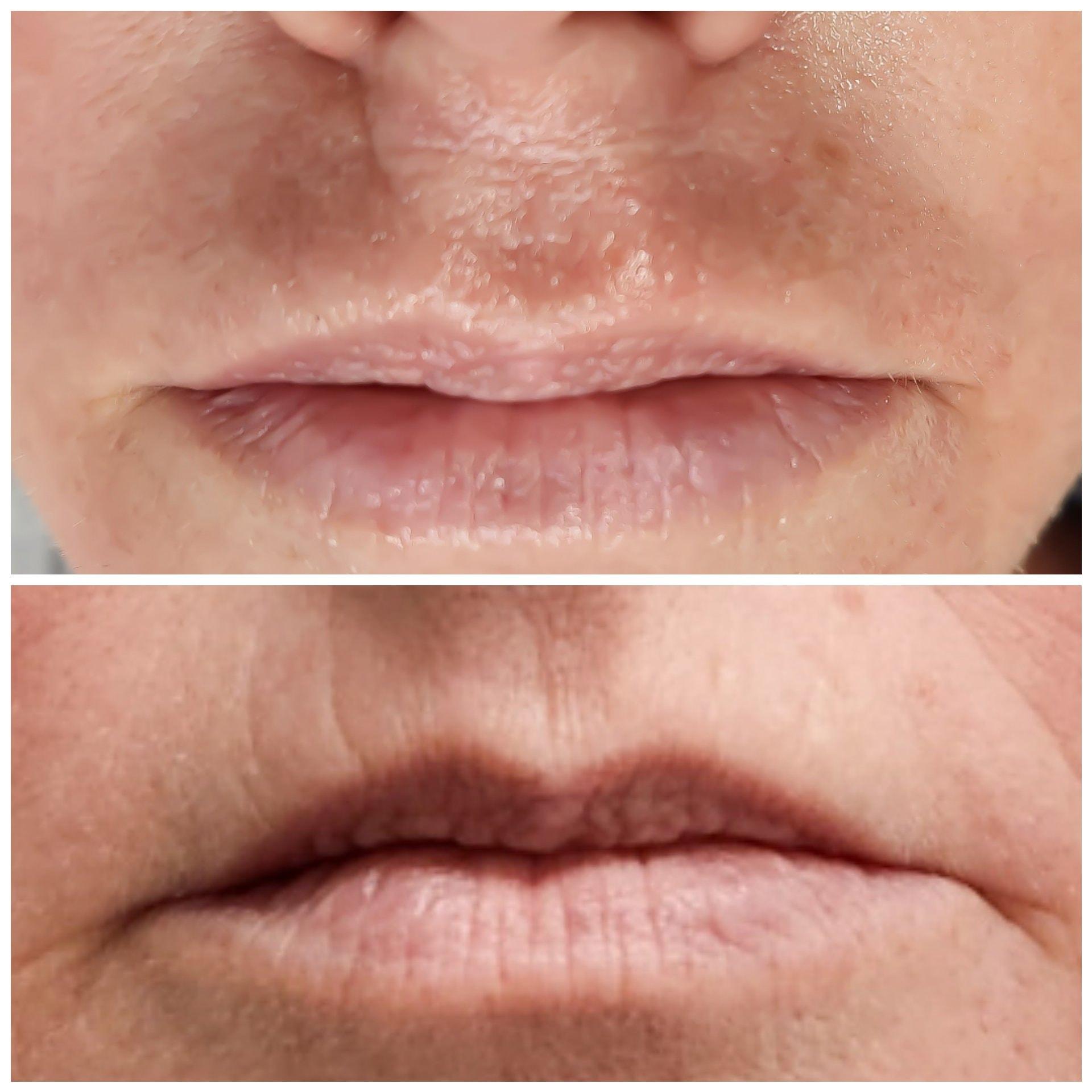 Bocaba Medspa laser treatment result — Sandy, UT
