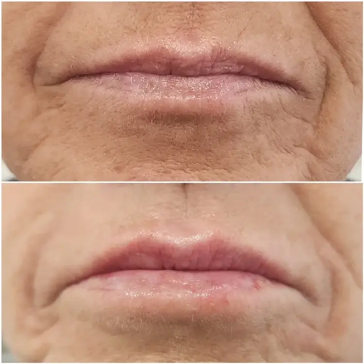 Bocaba Medspa lip filler result — Sandy, UT