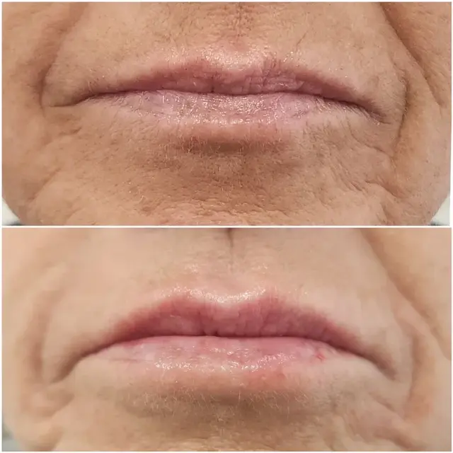 Lip Filler result at Bocaba Medspa in Sandy, UT