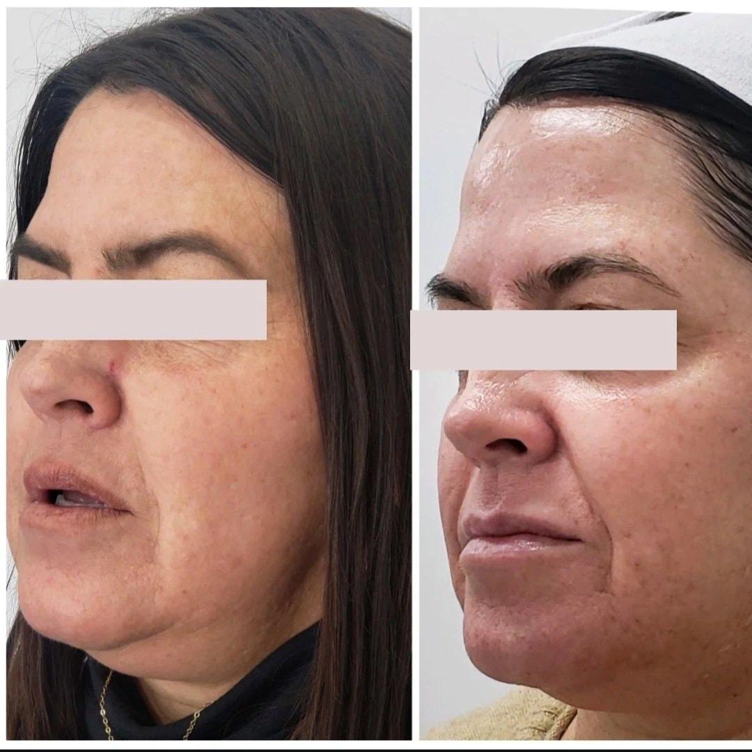 Bocaba Medspa laser treatment result — Sandy, UT