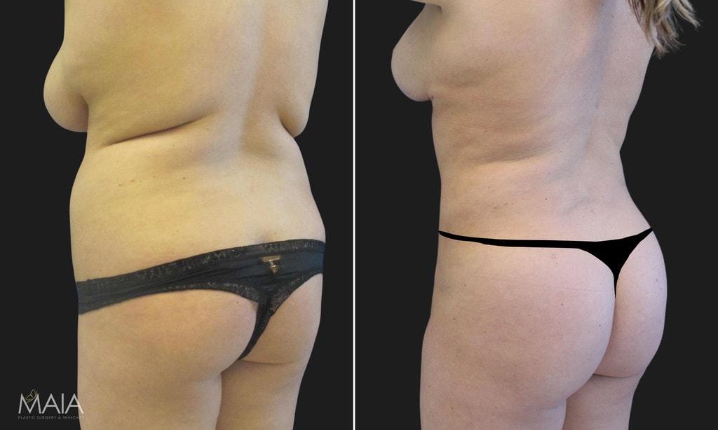 Maia Plastic Surgery (Munique Maia, MD) bbl result — Tysons, VA