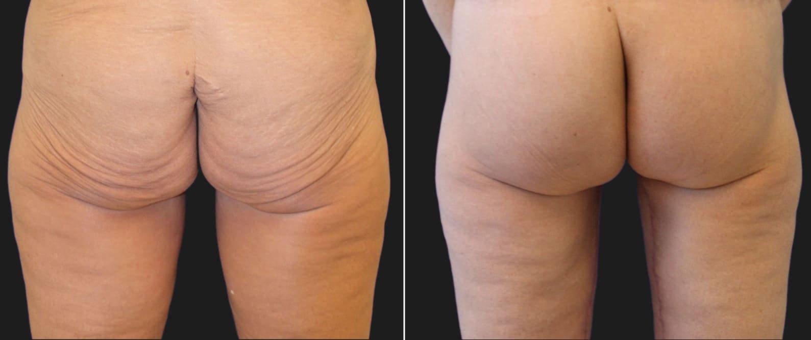Maia Plastic Surgery (Munique Maia, MD) bbl result — Tysons, VA