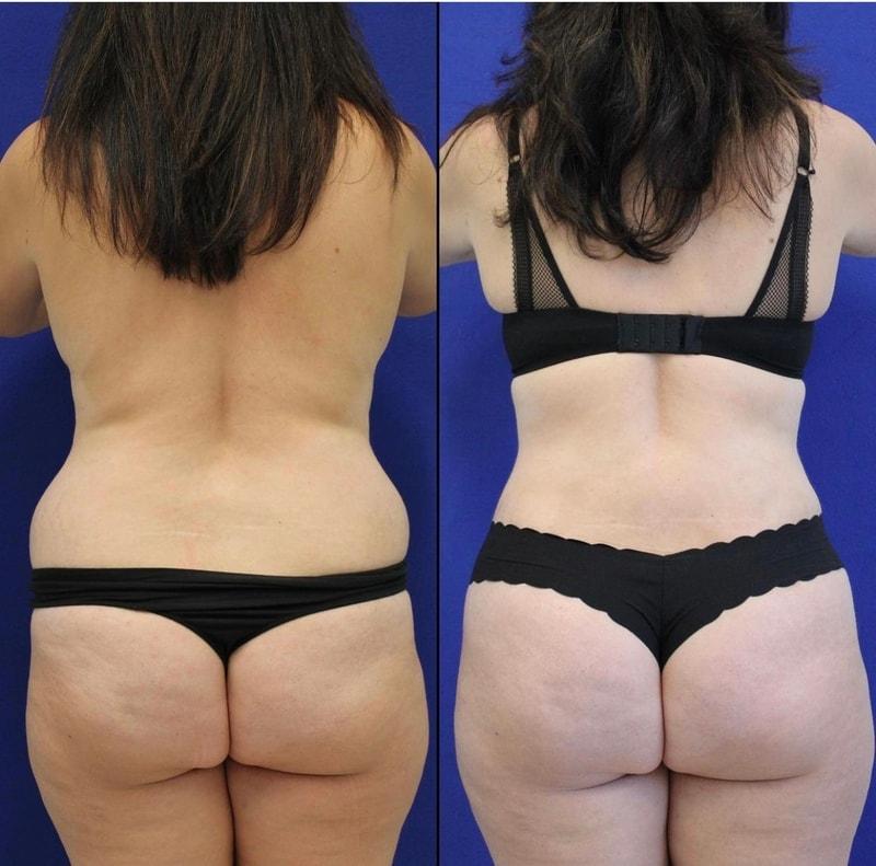 Maia Plastic Surgery (Munique Maia, MD) bbl result — Tysons, VA