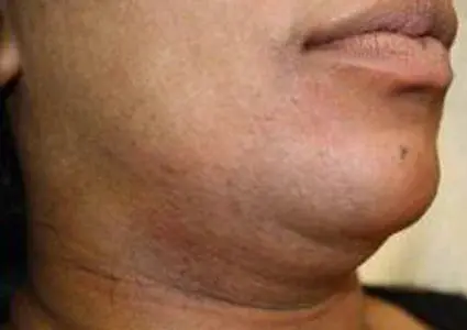 Dr. Iliana Sweis - North Shore Center for Plastic Surgery after — Northbrook, IL