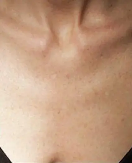 Dr. Iliana Sweis - North Shore Center for Plastic Surgery after — Northbrook, IL