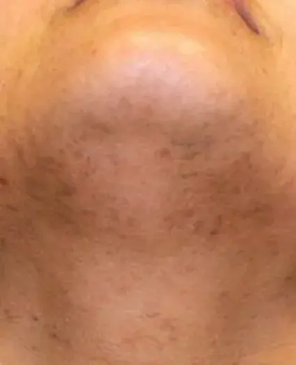 Dr. Iliana Sweis - North Shore Center for Plastic Surgery after — Northbrook, IL