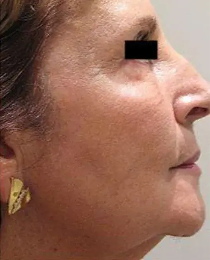 Dr. Iliana Sweis - North Shore Center for Plastic Surgery after — Northbrook, IL