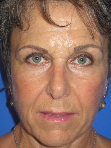 Haena Kim, MD facelift after — San Jose, CA