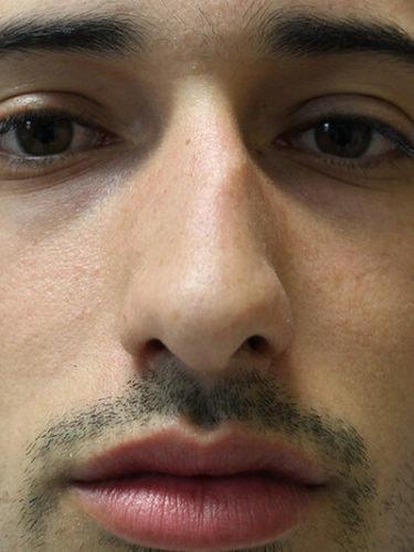 Rhinoplasty before at Haena Kim, MD in San Jose, CA