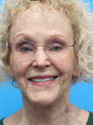 Haena Kim, MD facelift after — San Jose, CA