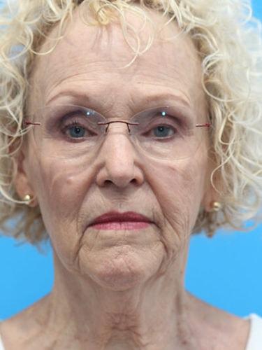 Deep Plane Facelift before at Haena Kim, MD in San Jose, CA