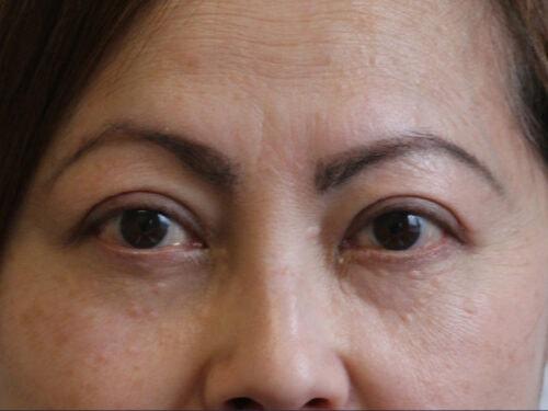 Haena Kim, MD eyelid lift after — San Jose, CA