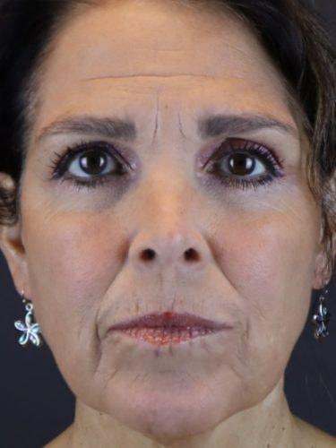 Deep Plane Facelift before at Haena Kim, MD in San Jose, CA