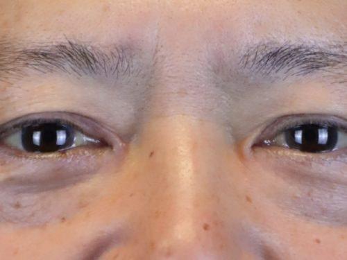 Blepharoplasty after at Haena Kim, MD in San Jose, CA