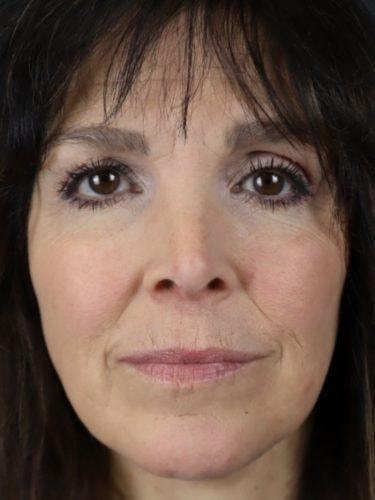 Deep Plane Facelift after at Haena Kim, MD in San Jose, CA