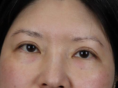 Haena Kim, MD eyelid lift after — San Jose, CA